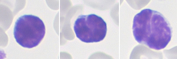 Lymphozyten bei Pertussis mikroskopisch