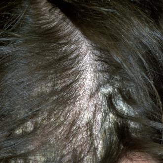 Psoriatischer Befall der behaarten Kopfhaut