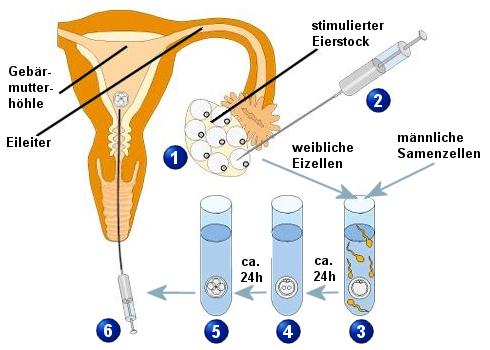 Schema einer in vitro Fertilisation