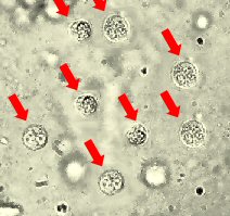 Weie Blutkrperchen im Harn im Mikroskop betrachtet