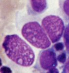 Bsartige Zellen eines Tumors der Schleimhaut der Harnwege