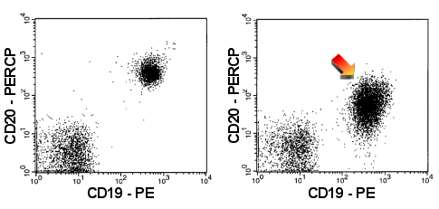 The malignant B-cells (right-hand dot-plot) show a weak expression of CD20