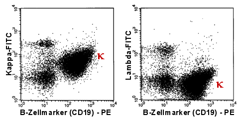 Kappa-monoklonale B-Zellen nach Doppelfrbung CD19 und Leichtkette